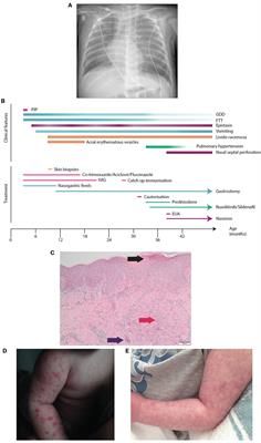 A Mutation Outside the Dimerization Domain Causing Atypical <mark class="highlighted">STING-Associated Vasculopathy With Onset in Infancy</mark>